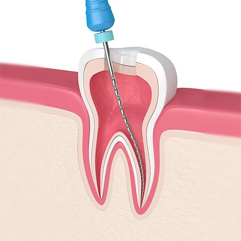 Endodoncia en Tarragona tratamiento Endodoncia en Tarragona tratamiento