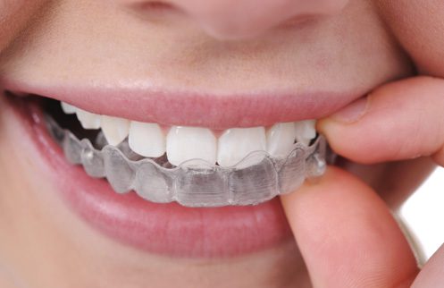 ortodoncia tarragona brackets removibles ortodoncia tarragona brackets removibles