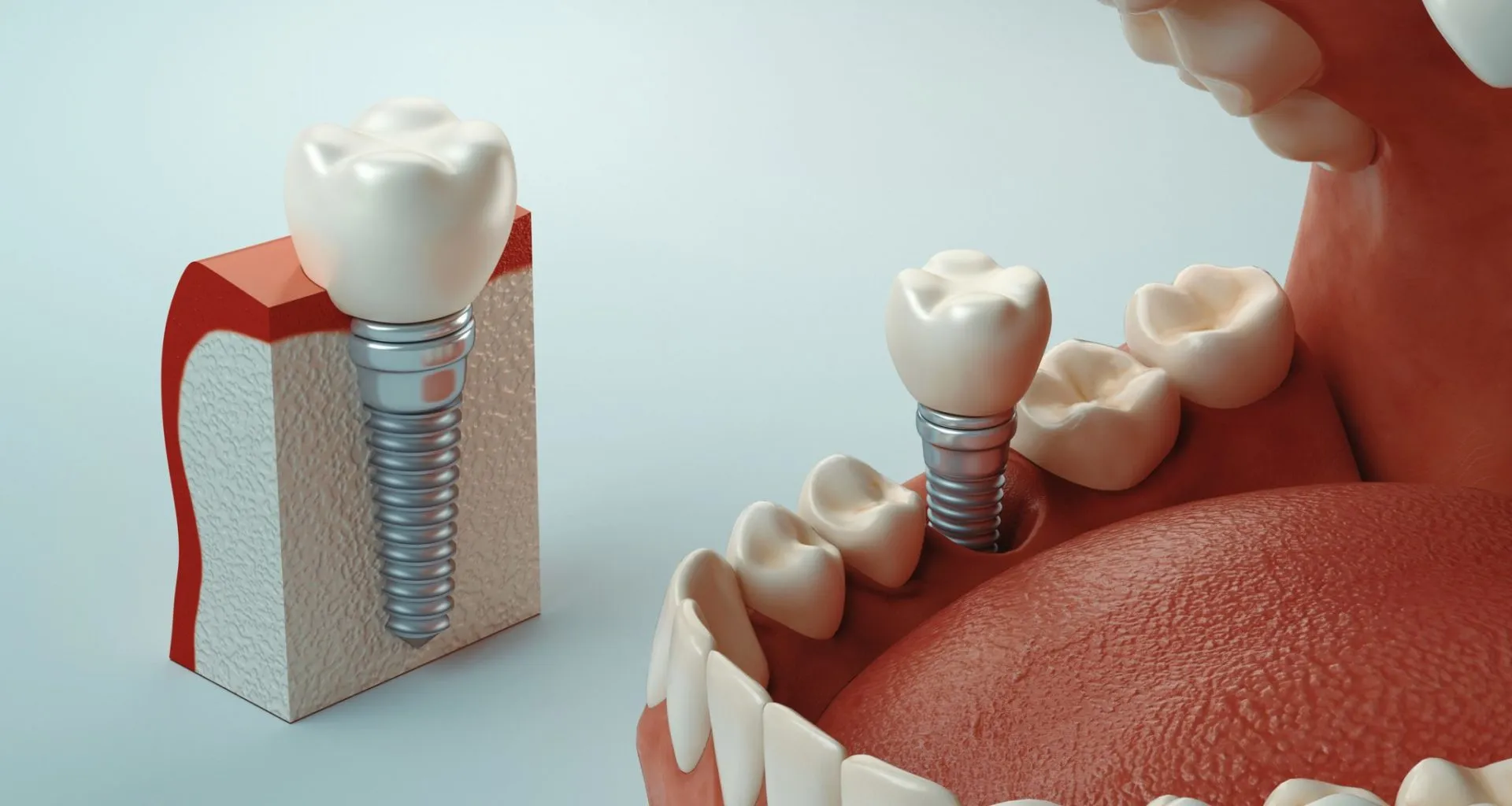 Implantología dental en Tarragona implante