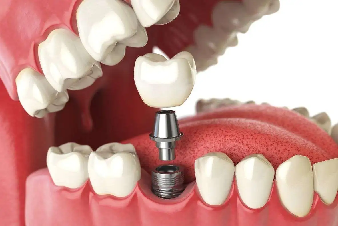 Implantología dental en Tarragona