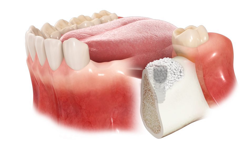 cirugía maxilofacial en Tarragona injerto de hueso