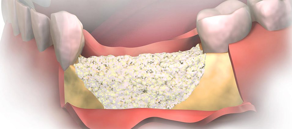 injertos de hueso en Tarragona injertos de hueso en Tarragona