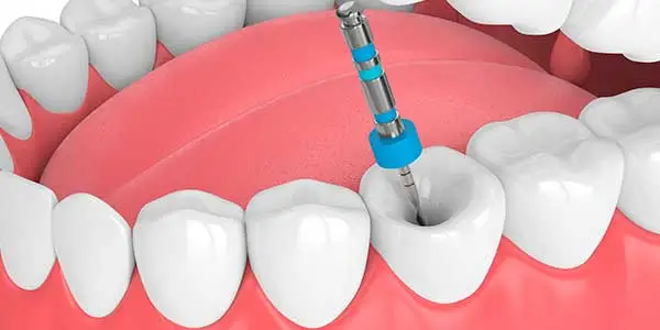 endodoncia en Tarragona Clínica dental