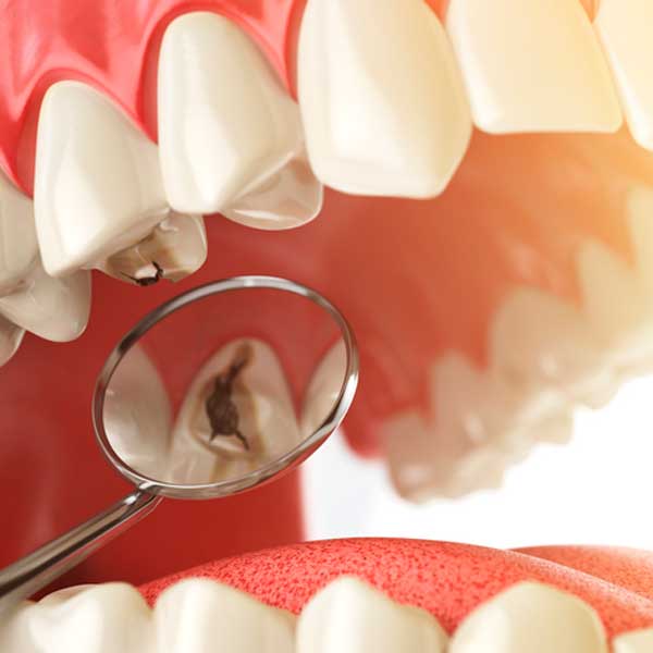 ¿Qué son las caries?