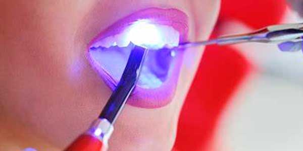 tratamiento dolor de muelas en Tarragona empaste