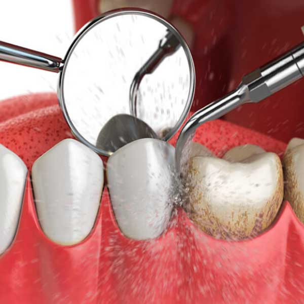 tratamientos dolor de encias en Tarragona sangrado de encias