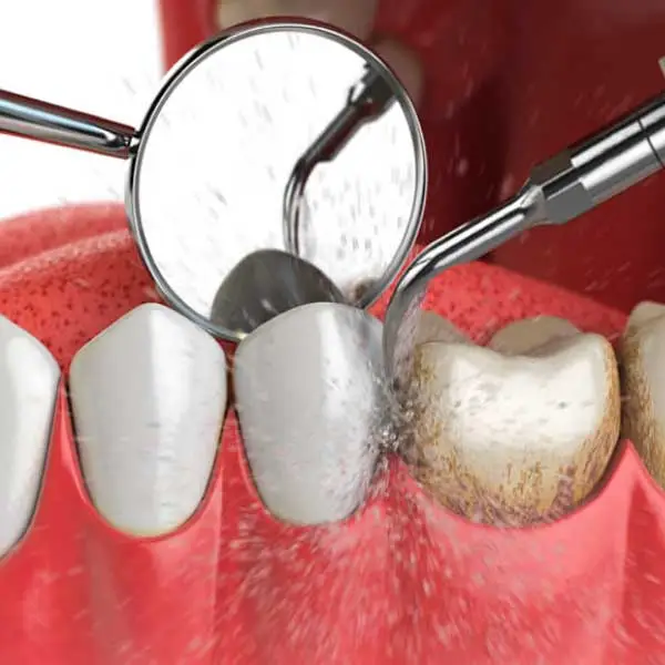 tratamientos dolor de encias en Tarragona sangrado de encias