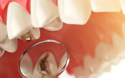 ¿Cuáles son los síntomas de caries?