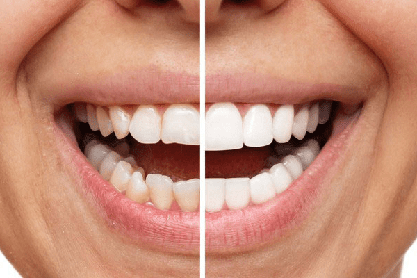 carillas dentales estética dental Tarragona