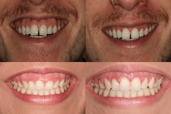 correcion de encias sonrisa gingival Tarragona