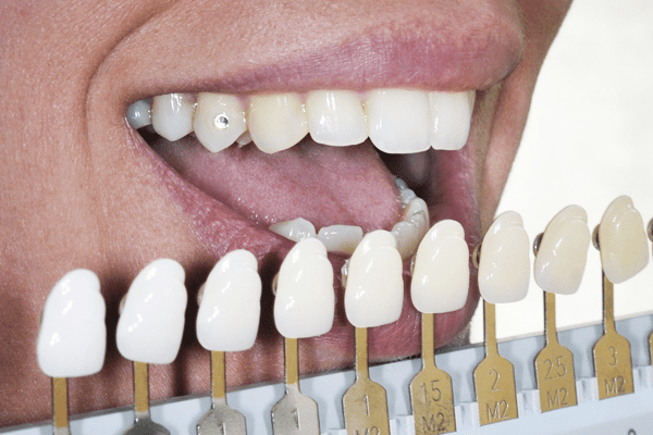 estética dental Tarragona blanqueamiento profesional