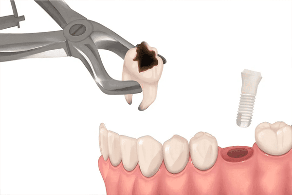 estética dental implantes dentales inmediatos