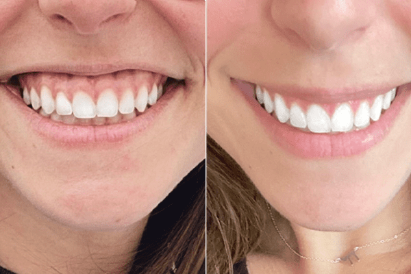 estética dental tarragona correción de encias