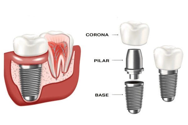 Estructura de un implante implantología en Tarragona odontologs Diso