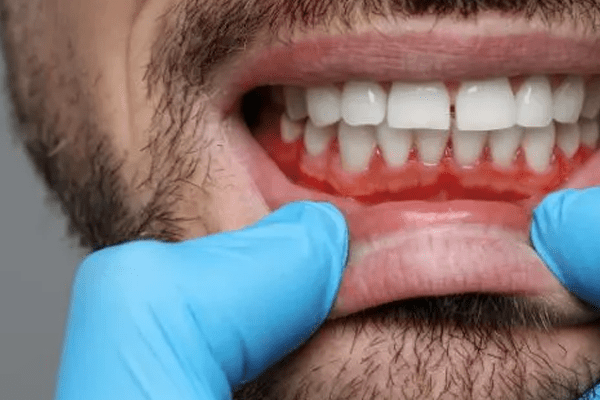 gingivitis enfermedades periodoncia tarragona gingivitis enfermedades periodoncia tarragona