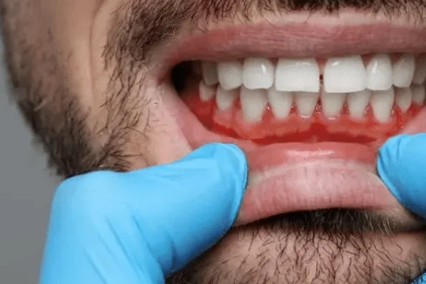 gingivitis enfermedades periodoncia tarragona