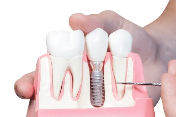 maqueta de un implante dental entre dos dientes sanos