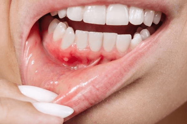 peridontitis Tarragona peridontitis Tarragona